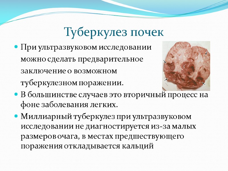 Туберкулез почек При ультразвуковом исследовании   можно сделать предварительное   заключение о